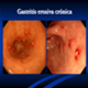 Gastritis cronica - imagenes