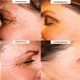 Botox бръчки лечение - снимки