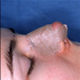 Hidung membentuk kembali (Rhinoplasty)  - Gambar
