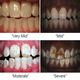 Fluorosis dental - imagenes