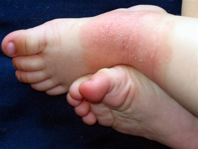Dermatita Atopica - imagini 