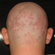 Dermatite Seborreica - fotos