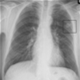 肺癌 - 图片
