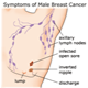 Cancro al seno negli uomini - foto