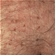 Pediculosis pubis - Gambar