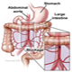 Infarto intestinale - foto