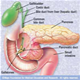 Acute pancreatitis - foto's