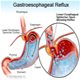 Gastroezofaginio refliukso - nuotraukos