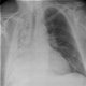 Atelettasia polmonare - foto