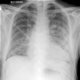 Edema polmonare - foto