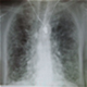 Plaučių fibrozė - nuotraukos