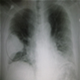 Pneumonia - Gambar