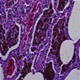 Alveolių hemoraginis sindromas - nuotraukos