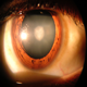 Cataract - bilder