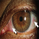Syndrome de l'oeil sec - photos