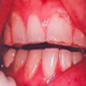 Zębów bruksizm szlifowania - zdjęcia