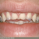 歯の侵食 - 写真