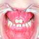 Hiperplazija dantenų - nuotraukos