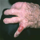 Φυσαλλιδώδες ασθένεια της αιμοκάθαρσης - εικόνες