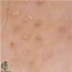 Lichen spinulosus - Bilder