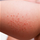 Kožní alergie - obrázky