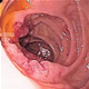 十二指腸の癌 - 写真