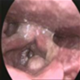 喉癌 - 图片