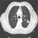 Cancer de pulmon - imagenes