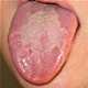 Geographic tongue - pictures