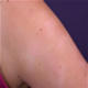 Pityriasis alba - pictures