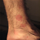 Pityriasis rosea - pictures