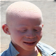 Albinism  - pictures